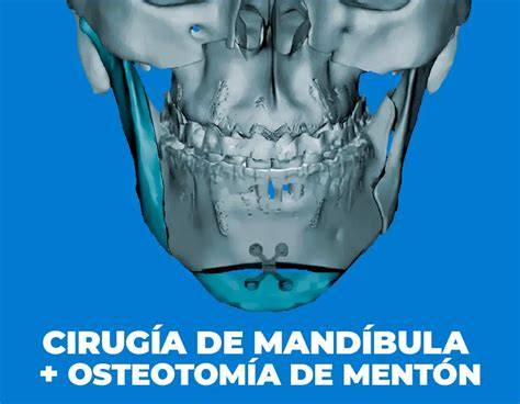 Diagrama de una osteotomía maxilar