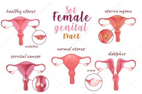 ilustración de la anatomía del tracto genital femenino con puntos de infección por Haemophilus spp.