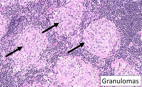 Imágenes histopatológicas mostrando granulomas no caseificantes, un hallazgo clave en la Enfermedad de Crohn