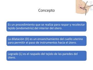 Representación esquemática del útero y los instrumentos utilizados en un procedimiento de dilatación y legrado (D&C)