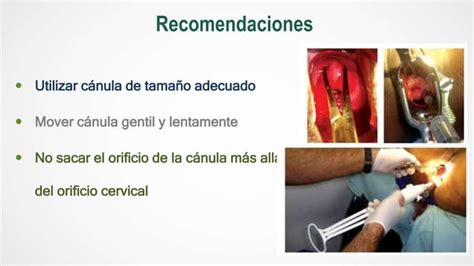 Infografía comparativa de diferentes métodos de evacuación uterina, incluyendo legrado por succión y legrado con cureta.