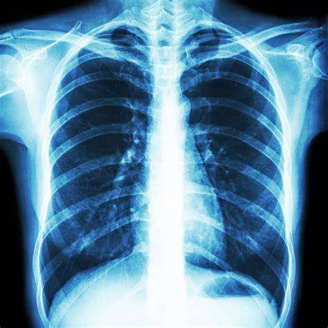 Foto de un cuello o tórax mostrando una protuberancia lisa en la piel característica del enfisema subcutáneo