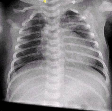 Radiografía de tórax neonatal mostrando enfisema subcutáneo, neumomediastino con el signo de las 
