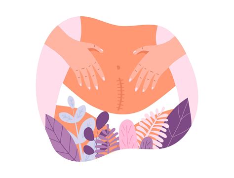 Ilustración de braguita de talle alto cubriendo una cicatriz de cesárea