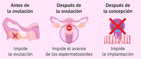 Infografía explicando el mecanismo de acción de los anticonceptivos de progestágeno solo