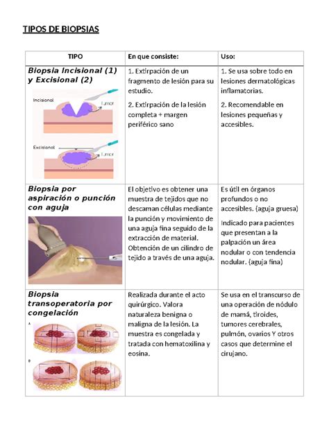 Esquema de las diferentes técnicas de biopsia de mama