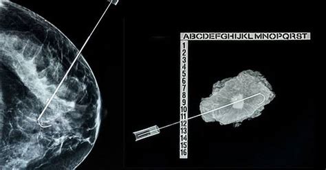 Procedimiento de biopsia de mama guiada por ultrasonido