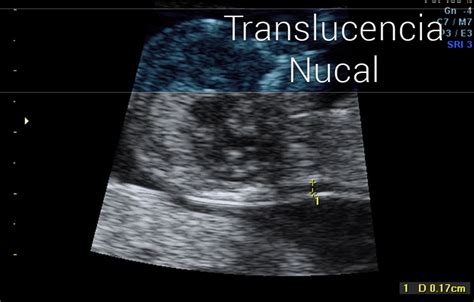 Imagen de ecografía mostrando la medición de la translucencia nucal en el primer trimestre del embarazo.