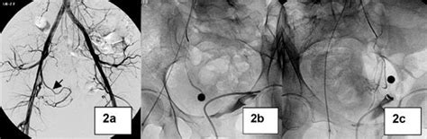 Angiografía pélvica mostrando la embolización arterial uterina