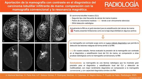Microfotografía de tejido mamario con cáncer ductal o lobulillar para contraste.