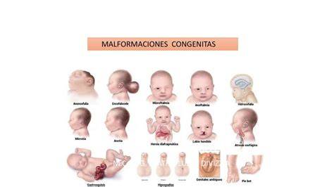 Esquema de los tipos de malformaciones congénitas más comunes