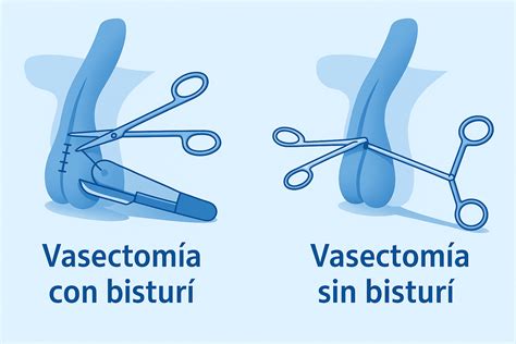 Diagrama de una vasectomía