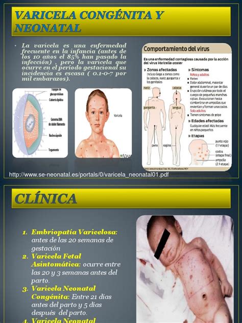 Infografía sobre los efectos del síndrome de varicela congénita en el feto