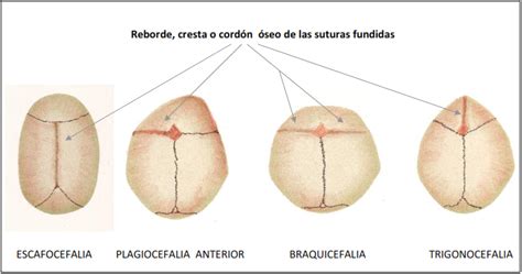 Ilustraciones comparativas de las diferentes formas de craneosinostosis (escafocefalia, braquicefalia, trigonocefalia, plagiocefalia)