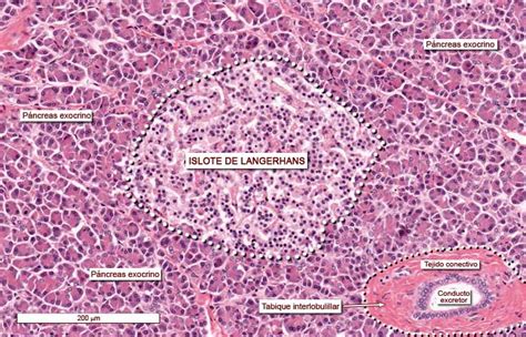 Microfotografía comparativa de un islote de Langerhans sano frente a uno inflamado y lesionado por diabetes tipo 1.