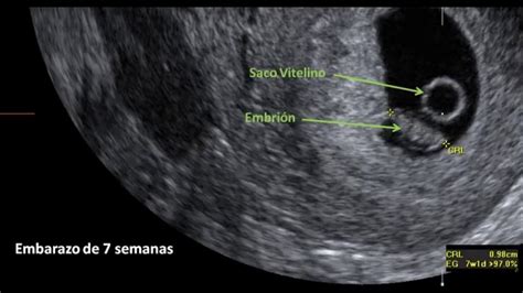 Ecografía obstétrica mostrando el saco gestacional temprano.