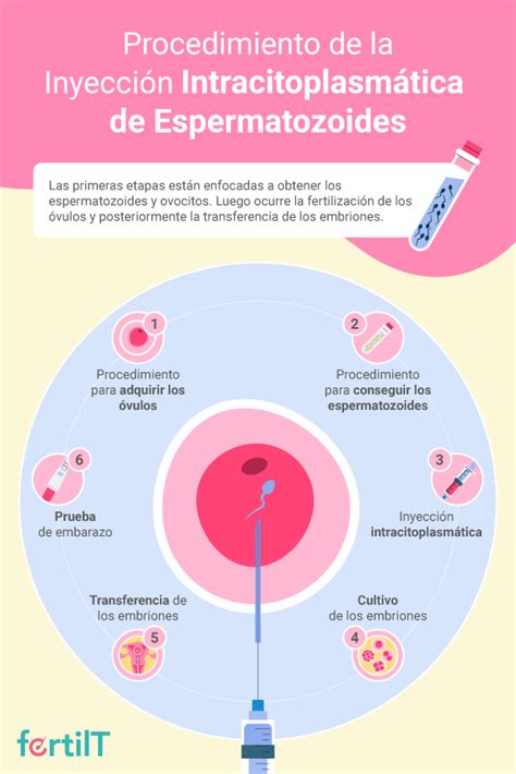 diagrama del procedimiento de microinyección intracitoplasmática de espermatozoides (ICSI)