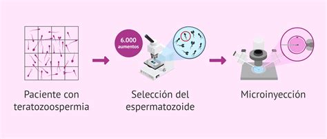 esquema de la técnica IMSI para selección de espermatozoides