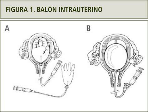 Imagen de un balón intrauterino o esquema de ligadura de arterias hipogástricas