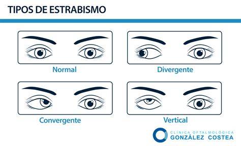Ejemplos de estrabismo convergente y divergente en niños