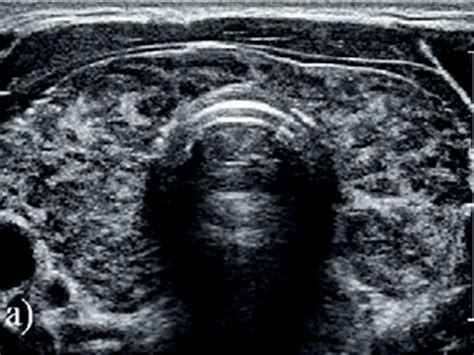 ecografía de una glándula tiroidea con tiroiditis de Hashimoto, mostrando inflamación y posible nodularidad