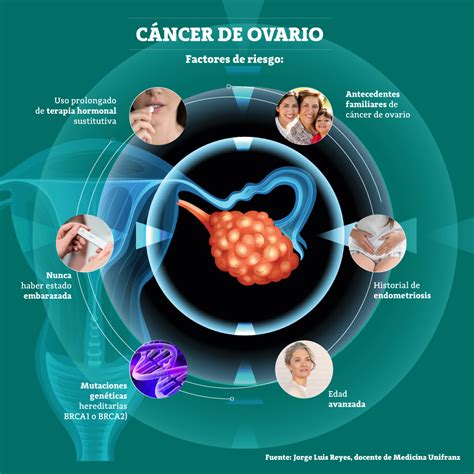 Infografía sobre los factores de riesgo del cáncer de ovario
