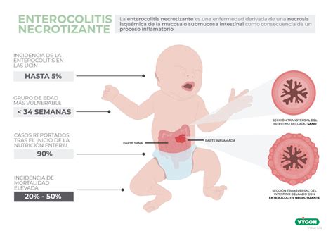 Diagrama que ilustra los factores que contribuyen a la enterocolitis necrosante: isquemia, colonización bacteriana, alimentación enteral y barrera intestinal inmadura.