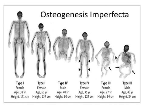 Esquema de los diferentes tipos de osteogénesis imperfecta y sus características clínicas principales