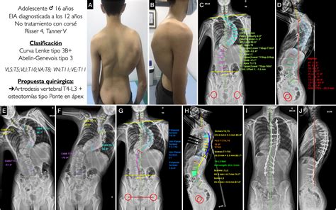 Radiografía de columna vertebral mostrando cifoescoliosis severa en un paciente con osteogénesis imperfecta