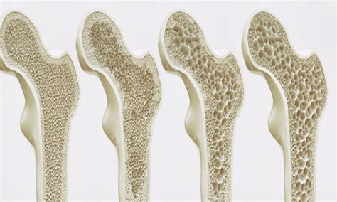 Gráfico mostrando la densidad mineral ósea en diferentes tipos de osteogénesis imperfecta