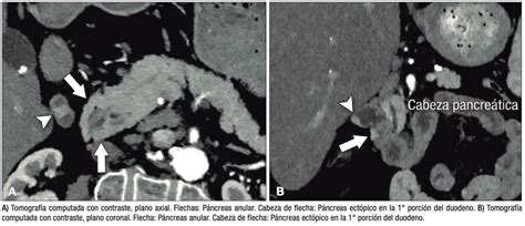 Imagen endoscópica de una lesión subepitelial gástrica causada por páncreas ectópico