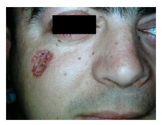 Foto de una persona con múltiples carcinomas basocelulares típicos del Síndrome de Gorlin