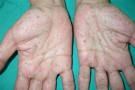 Fotografía de pits palmoplantares característicos en pacientes con Síndrome de Gorlin