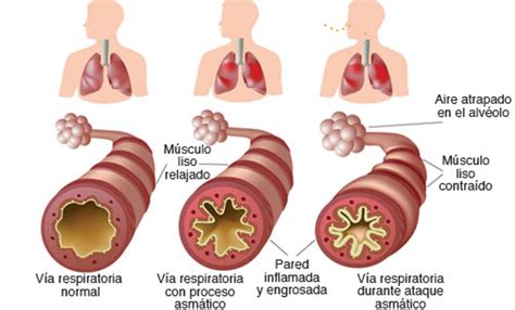 Diagrama que ilustra las vías respiratorias afectadas por la rinitis y el asma, y los puntos de acción de la fluticasona