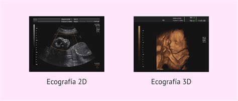 Ecografía 3D de pies fetales a las 34 semanas