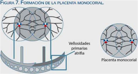 Esquema de placenta monocorial con anastomosis vasculares entre gemelos