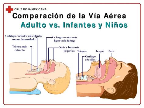 Ilustración de las diferencias anatómicas de la vía aérea en un niño vs. un adulto