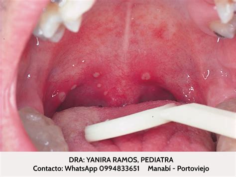 Ilustración de la boca de un niño con úlceras características de la herpangina.