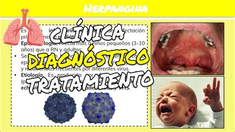 Infografía mostrando las vías de transmisión de la herpangina: contacto directo, secreciones respiratorias y contacto con superficies contaminadas.