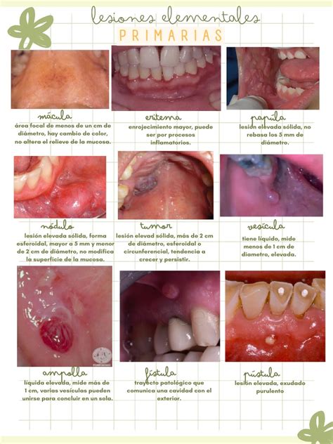 Comparativa visual de las lesiones bucales de la herpangina con las de la enfermedad boca-mano-pie.