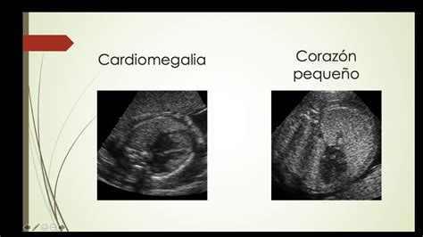 Imagen ecográfica de las cuatro cavidades del corazón fetal.