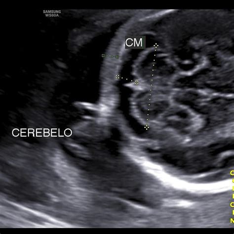 Imagen ecográfica del cerebelo fetal.