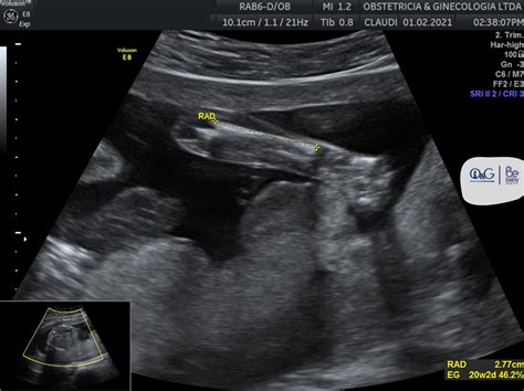 Imagen ecográfica de la columna cervical fetal.