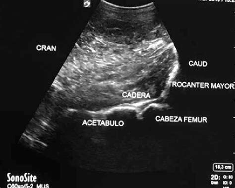 Imagen ecográfica del fémur fetal.