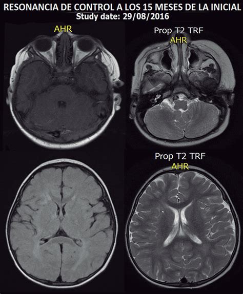 Resonancia magnética cerebral de un neonato con daño hipóxico-isquémico