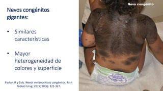 Foto de un neonato con nevo melanocítico congénito gigante en el cuerpo