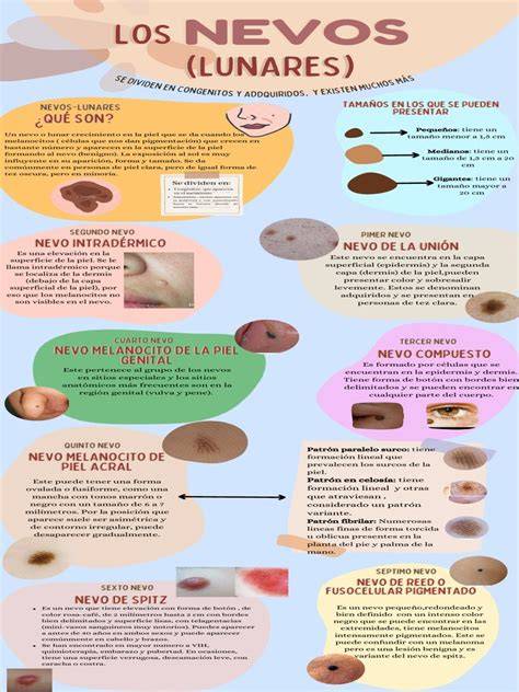 Infografía con los diferentes patrones de distribución de los nevos melanocíticos congénitos gigantes