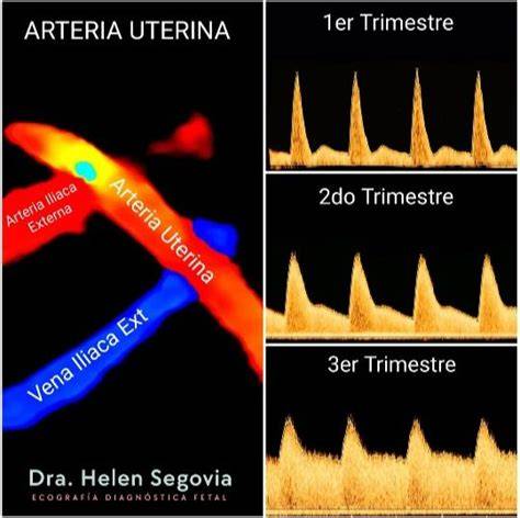 Esquema de la ecografía Doppler de la arteria uterina en el primer trimestre