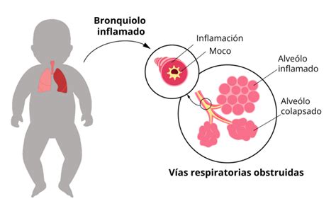 Esquema de las vías respiratorias afectadas por la bronquiolitis en un bebé