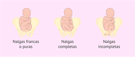 Ilustración detallada de los tres tipos de presentación de nalgas: franca, completa e incompleta.
